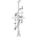 Guaranteed Quality Semi-circular External Fixator Orthopedic Surgical Implant thumbnail-7