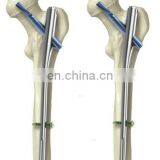 Orthopedic Trauma Implants PFNA thumbnail-3