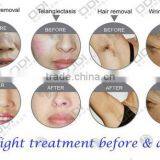 Beauty Machine Beauty Salon/spa OD-IRL10 nd Yag Tattoo Removal Hair Removal RF E Light Laser Ipl thumbnail-6