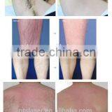 OEM Available Alexandrite Laser 755nm Hair Removal Equipment thumbnail-6