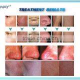 Removing Spider Veins Nose / Treatment Spider Veins Nose / Vascular Machines Spider Vein thumbnail-4