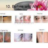 FDA Elight Ipl Hair Removal Machine Med-230 thumbnail-4