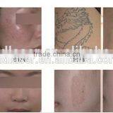 Best Price Mini q Switch 1064 nm 532nm nd Yag Laser Home Use Tattoo Removal Skin Rejuvenation Beauty Salon Mahicne thumbnail-6