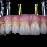 Dental implant prosthesis, implant denture, dental prosthesis, laboratoire dentaire, Dentallabor, laboratorio dental, dental laboratory, Shenzhen LJ dental lab China