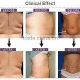 Oem Odm Safe and Effective Radio Frequency Ultrasonic Cavitation Freeze Fat Reducing Fat Apparatus For Sale thumbnail-6