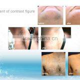 Permanent YUWEI Professional Hair Removal 808 Diode Laser/Salon Use 808 Nm Diode Laser Hair Removal Machine Women thumbnail-6