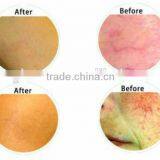 Vascular / Veins / Spider Veins Removal 940nm / 980nm Diode Laser Medical Product thumbnail-6