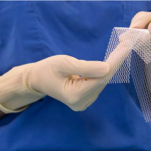 Surgical polypropylene mesh for hernia repair