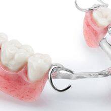 REMOVABLES | PARTIALS VALPLAST® Flexible Partial Dental Lab thumbnail-4