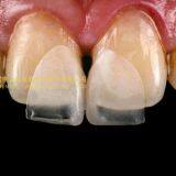 Ultra-thin Dental Veneers, Porcelain Veneer, Dental Laminates, Laboratoire Dentaire, Dentallabor, Laboratorio Dental, Dental Laboratory, Shenzhen LJ Dental Lab China thumbnail-1