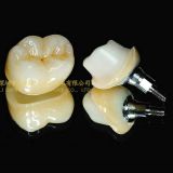 Dental implant abutment, implant crown, implant prosthesis, laboratoire dentaire, Dentallabor, laboratorio dental, dental laboratory, Shenzhen LJ dental lab China