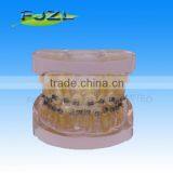 Orthodontic Teeth Model(Transparent Model , Dislocation Tooth, Common Brackets),dental Orthodontic Models thumbnail-1