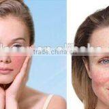 MBT 980nm Diode Laser for Vascular Lesions and Spider Veins Machine thumbnail-5