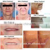 Fractional Radiofrequency Micro Needles for Permanent Makeup thumbnail-6