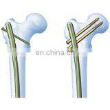 Femoral Intramedullary Nail Set thumbnail-2