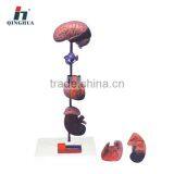 Hypertension Model,6-part