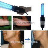 311nm Vitiligo Psoriasis Treatment Handheld House Use uv Lamp thumbnail-4