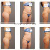 Permanent Body Slimming Ultrashape/Best Slimming Machine Ultrashape/High Quality Ultrashap Machine for Salon thumbnail-6