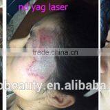 Malaysia Best q Switched nd Yag Laser Tattoo Removal Equipment Price thumbnail-6