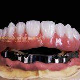 Dental Implant Bar, Implant Overdenture, Implant Prosthesis, Laboratoire Dentaire, Dentallabor, Laboratorio Dental, Dental Laboratory, Shenzhen LJ Dental Lab China thumbnail-3