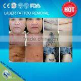 TUV Medical CE Approved Continuou Working Q-Switch Nd Yag Tattoo Removal Laser Machine thumbnail-6