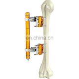 Конкурентоспособная цена. Ортопедические хирургические инструменты. Внешний фиксатор диафиза плечевой кости. Ортопедические хирургические имплантаты. Медицинские инструменты