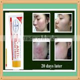 VC ANTI-ACNE CREAM Face Cream for dull and dark skin pure and natural whitening skin in 2 weeks skin care