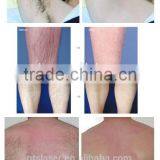 Multifunction Yag Laser Hair Removal Multi-languages Large Spot Size With Russia Imported Rod thumbnail-4