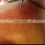 Factory Rbs Hot Sale Vein Removal Skin Care/spider Vein Skin Tag Removal Device/spider Vein Skin Mole Removal thumbnail-5
