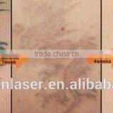 ND Yag Laser Tattoo Removal Machine Vascular Tumours Treatment Mini Q Switch ND Yag Laser MINI-C6 Tattoo Laser Removal Machine thumbnail-5