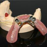 Dental Telescope Denture, Telesope Crown, Dental Prosthesis, Laboratoire Dentaire, Dentallabor, Laboratorio Dental, Dental Laboratory, Shenzhen LJ Dental Lab China thumbnail-4