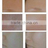 Eye Wrinkle / Bag Removal Professional Portable Co2 FDA Approved Laser Warts Removal Tube/co2 Fractional Laser Machine 0.1mj-300mj thumbnail-6