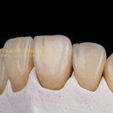 Dental crown zirconia Cercon,dental teeth,dental prosthesis laboratoire dentaire, Dentallabor, laboratorio dental, dental laboratory, Shenzhen LJ dental lab
