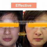 Vertical Ipl e Light Skin Care Machine/ipl Skin Rejuvenation Instrument thumbnail-5