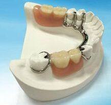 Cercon Zirconia Crown, Wieland Zenostar HT Zirconium, porcelain crown, dental crown