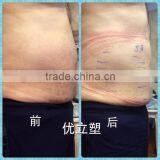 Ultrashape New Slimming Technology Machine Cavitation Slimming Machine thumbnail-6