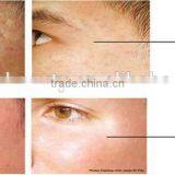 2016 Express Micro Needle rf / Fractional rf Microneedle Sale /radio Frequency Wrinkle Removal and Skin Rejuvenation thumbnail-6