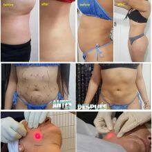 Portable Endolaser Machine Liposuction Fat Burning 1470NM Laser Slimming With CE thumbnail-2