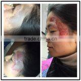 Professional Tattoo Anesthetic Tattoo Machines Q-Switch ND Yag Laser Machine For Laser Tattoo Removal or Birthmark Removal thumbnail-6