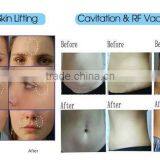 2015 Cavitation Ultrasonic Liposuction RF Vacuum Therapy Machine thumbnail-6
