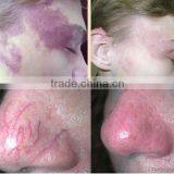 MBT 980nm Diode Laser for Vascular Lesions and Spider Veins Machine thumbnail-6