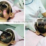 Pigment Removal Tattoo Removal About Portable Q-Switch Nd YAG Laser thumbnail-6
