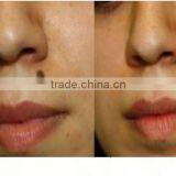 0.5HZ 2016 Best Q Switch Nd Yag Laser Tattoo Freckles Removal Removal Machine/ Tattoo Anesthetic Laser Tattoo Removal Machine Price thumbnail-5