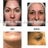 No-needle rf Skin Instrument for Facial Care Wrinkle Removal and Skin Tightening Whitening thumbnail-4