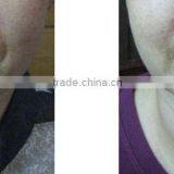 Ultrasound Therapy Hifu Facelift Wrinkle Skin Tightening Removal Spa Use Machine Portable thumbnail-4