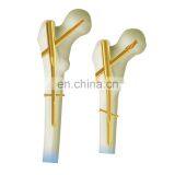 Titanium Intramedullary Nails.PFNA.PFNA Nail thumbnail-2