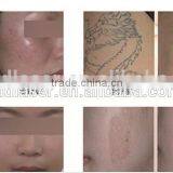 Best Q-switched Nd: Yag Laser thumbnail-6