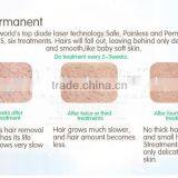 808nm Diode Laser Fast Permanent Hair Removal Machine/diode Laser Device Portable thumbnail-5