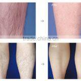 e Light Ipl rf nd Yag Laser Spot and Freckle Removal Machine thumbnail-4