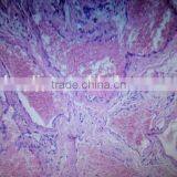 Cavernous Hemangioma Microscope Prepared Oral Pathology Teaching Slides